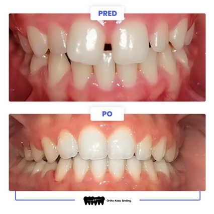 Prečo zuby nerastú vždy ideálne