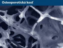 osteoporoticka kost