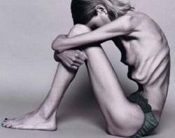 anorexia